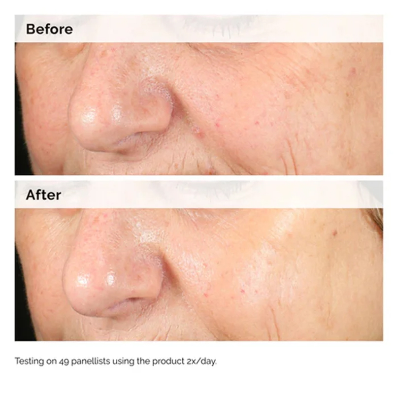 เซรั่มอัลฟ่าอาร์บูติน 2% + ไฮย - Aha Bha Exfoliant บทวิจารณ์และราคา