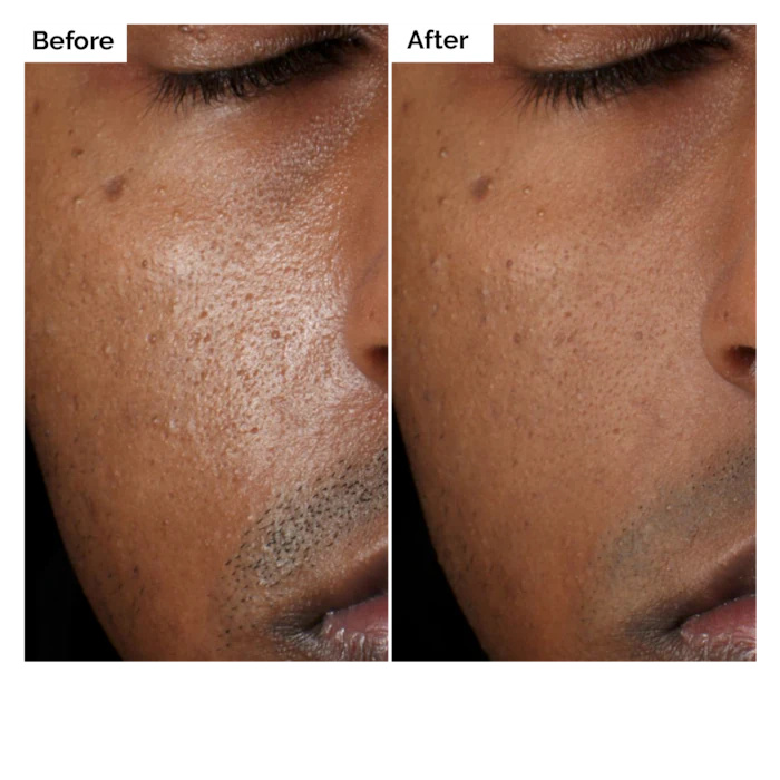 เซรั่มว่านหางจระเข้ 2% + NAG 2 - Aha Bha Exfoliant บทวิจารณ์และราคา